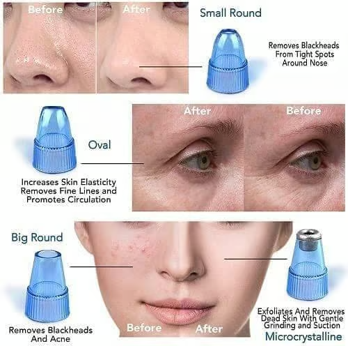 ✨Crispy 4 in 1 Multi-Function Blackhead Whitehead Extractor Remover Device